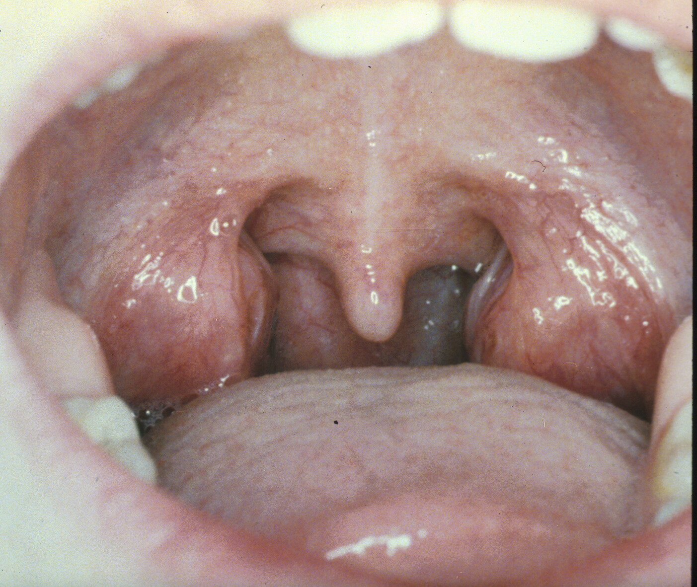 When Do Babies Develop Tonsils?